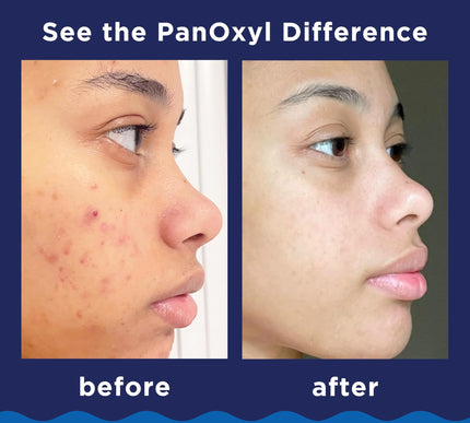 Product Image 6 - PanOxyl Acne Foaming W