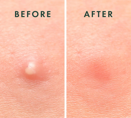 Product Image 5 - Rael Pimple Patches Mi